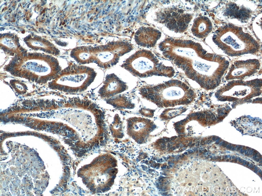 Immunohistochemistry (IHC) staining of human colon cancer tissue using BCL7B Polyclonal antibody (11740-1-AP)