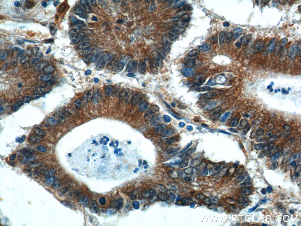 Immunohistochemistry (IHC) staining of human colon cancer tissue using BCL7B Polyclonal antibody (11740-1-AP)