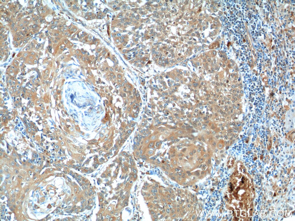 Immunohistochemistry (IHC) staining of human lung cancer tissue using BCL7B Polyclonal antibody (11740-1-AP)