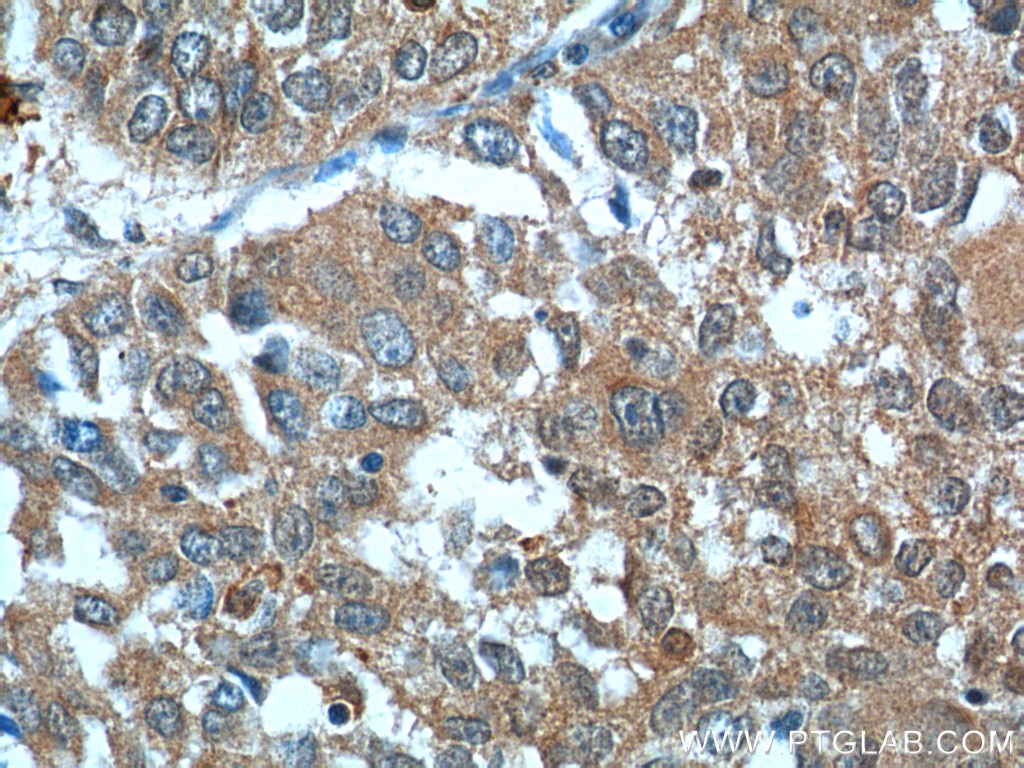 Immunohistochemistry (IHC) staining of human lung cancer tissue using BCL7B Polyclonal antibody (11740-1-AP)