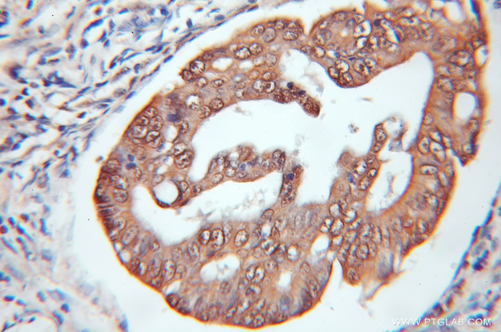 Immunohistochemistry (IHC) staining of human colon cancer tissue using BCL7B Polyclonal antibody (11740-1-AP)