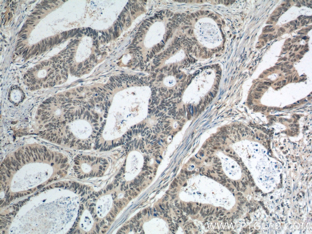 Immunohistochemistry (IHC) staining of human colon cancer tissue using BCL9 Polyclonal antibody (22947-1-AP)