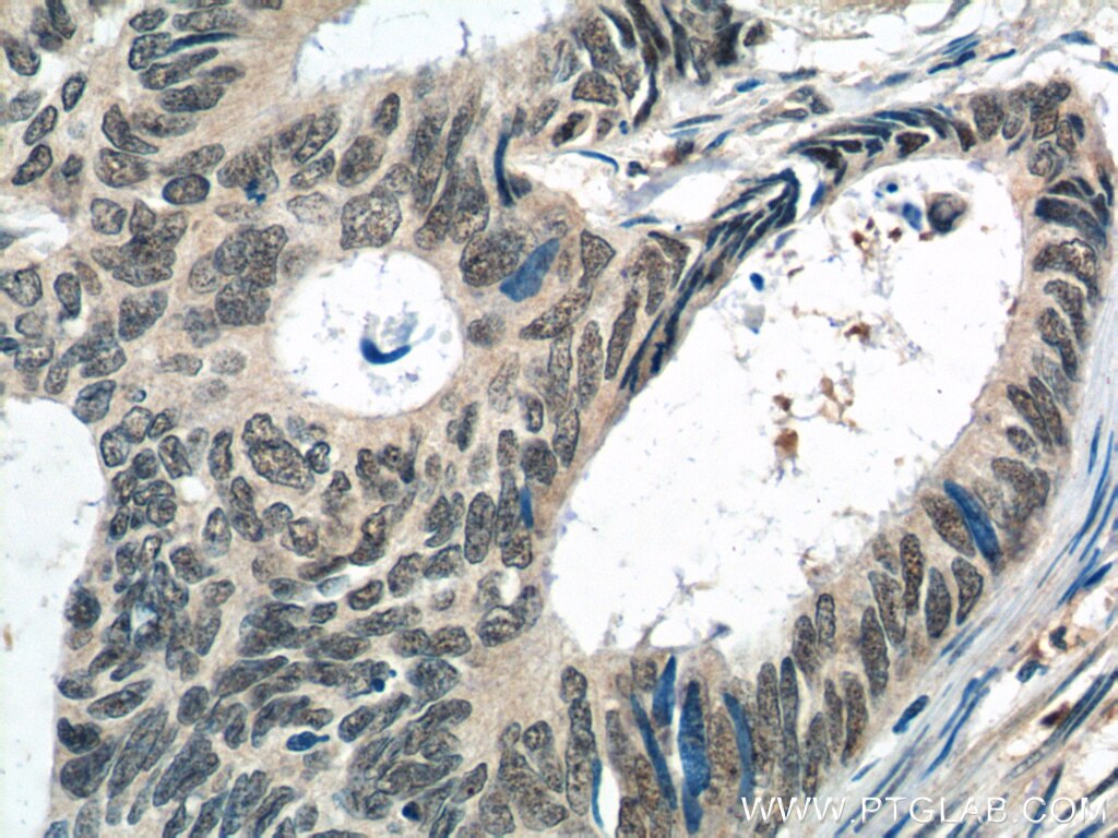 IHC staining of human colon cancer using 22947-1-AP