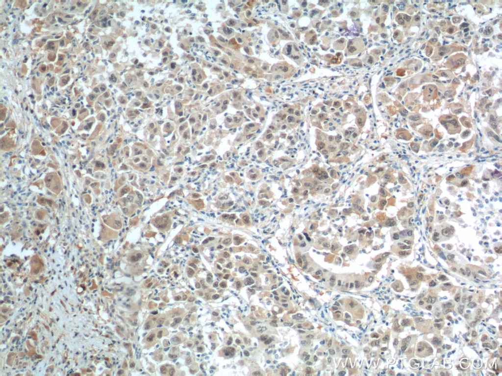 Immunohistochemistry (IHC) staining of human liver cancer tissue using BCL9 Polyclonal antibody (22947-1-AP)