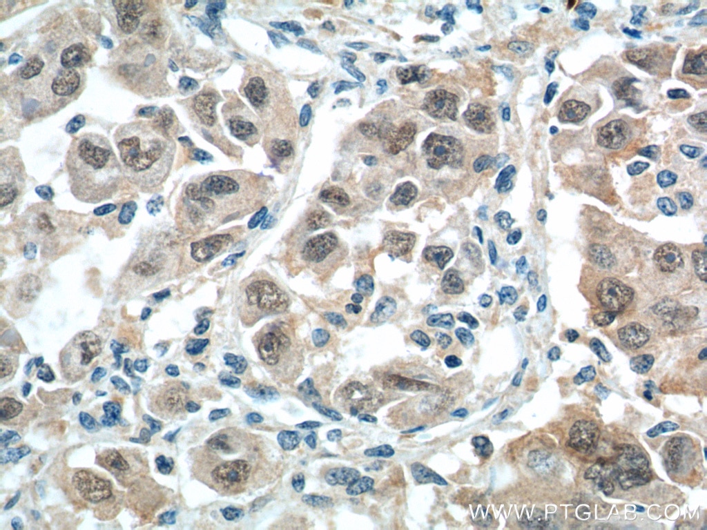 Immunohistochemistry (IHC) staining of human liver cancer tissue using BCL9 Polyclonal antibody (22947-1-AP)