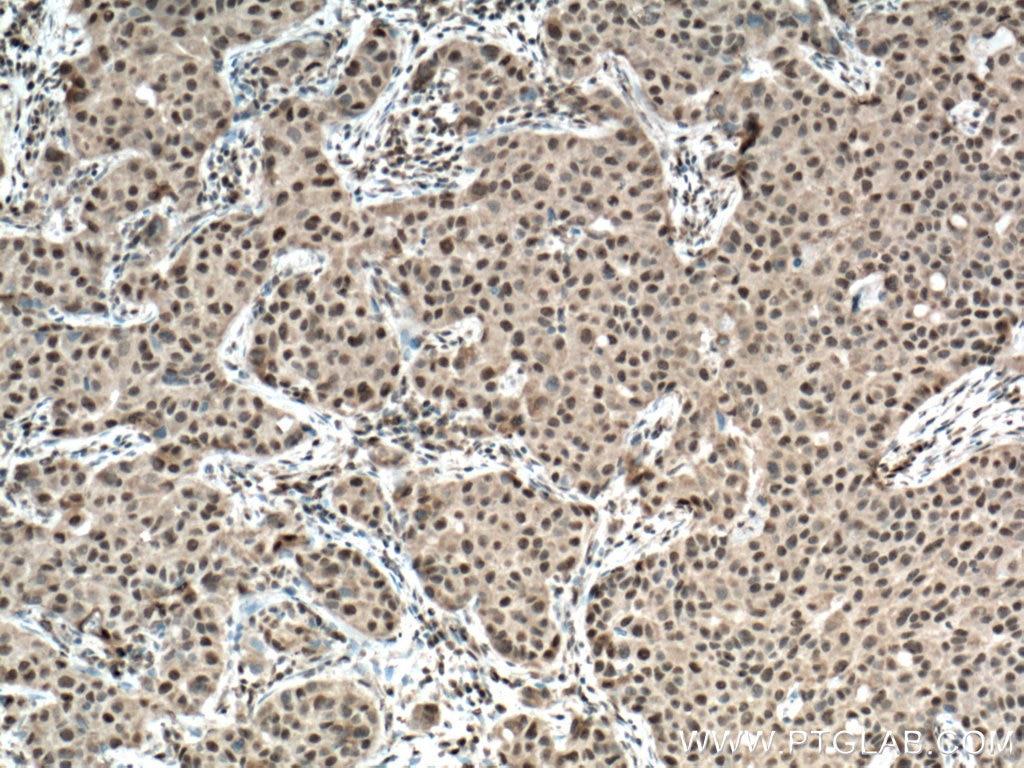 IHC staining of human breast cancer using 12107-1-AP