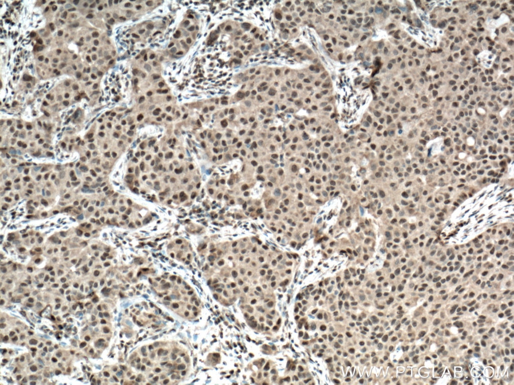 Immunohistochemistry (IHC) staining of human breast cancer tissue using BCOR Polyclonal antibody (12107-1-AP)