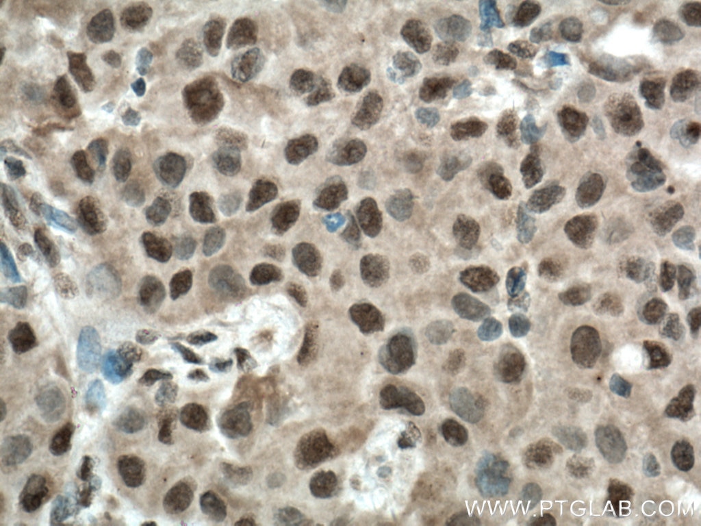 Immunohistochemistry (IHC) staining of human breast cancer tissue using BCOR Polyclonal antibody (12107-1-AP)
