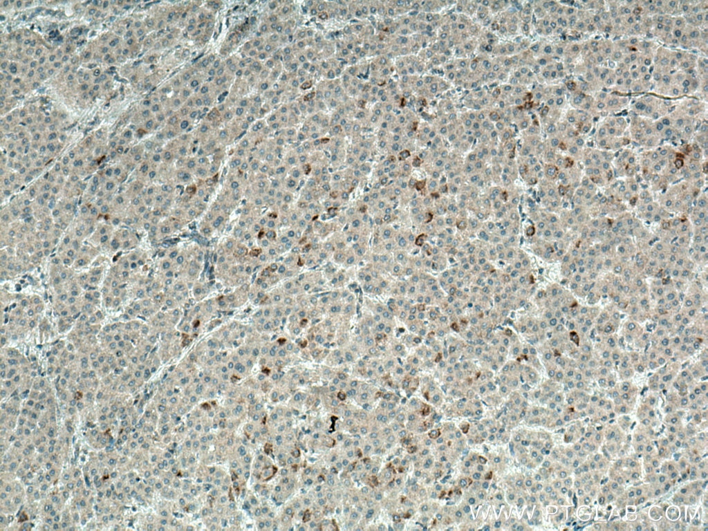 IHC staining of human liver cancer using 27286-1-AP