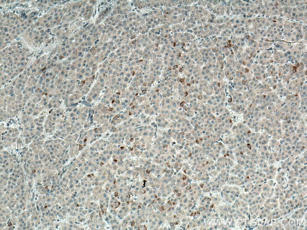 Immunohistochemistry (IHC) staining of human liver cancer tissue using BCRP,ABCG2 Polyclonal antibody (27286-1-AP)