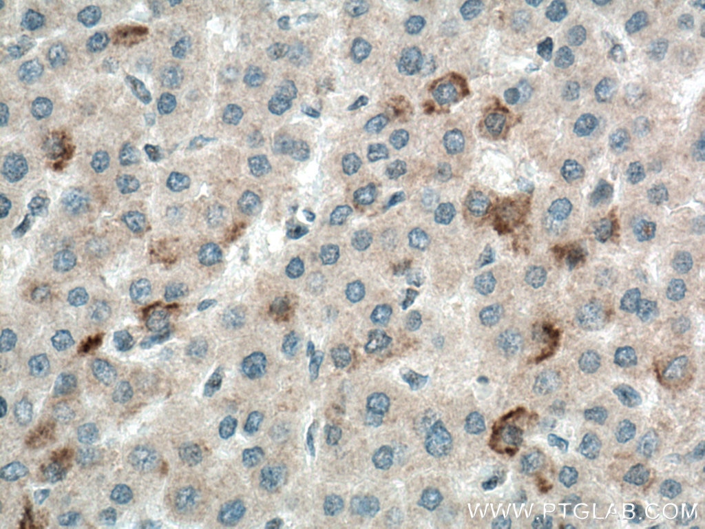 Immunohistochemistry (IHC) staining of human liver cancer tissue using BCRP,ABCG2 Polyclonal antibody (27286-1-AP)