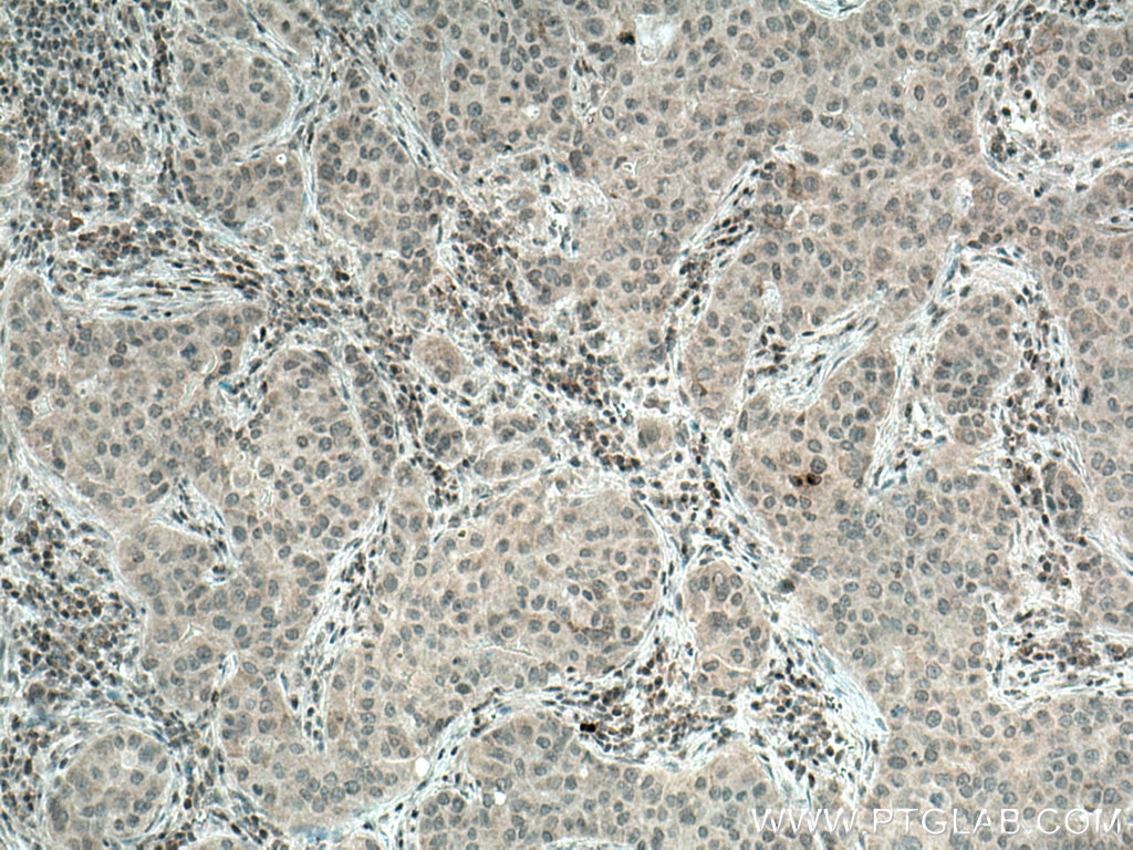 Immunohistochemistry (IHC) staining of human breast cancer tissue using BCRP,ABCG2 Polyclonal antibody (27286-1-AP)