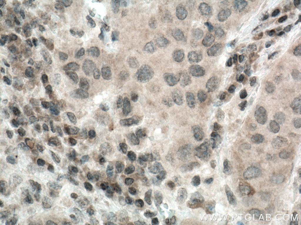 Immunohistochemistry (IHC) staining of human breast cancer tissue using BCRP,ABCG2 Polyclonal antibody (27286-1-AP)