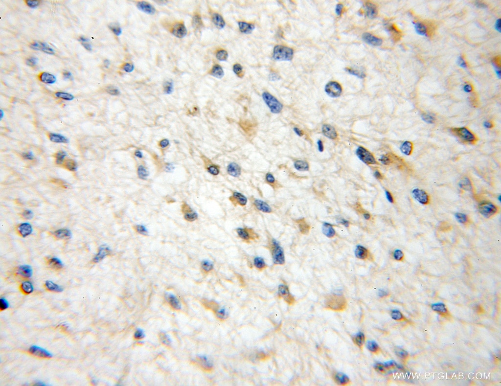 Immunohistochemistry (IHC) staining of human gliomas tissue using BCS1L Polyclonal antibody (10175-2-AP)