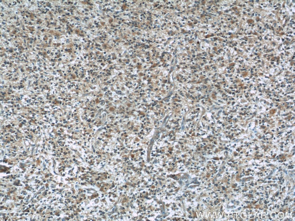 Immunohistochemistry (IHC) staining of human gliomas tissue using BCS1L Monoclonal antibody (60212-1-Ig)