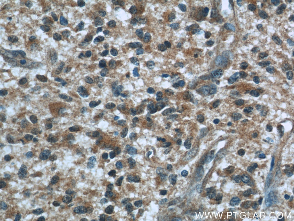 Immunohistochemistry (IHC) staining of human gliomas tissue using BCS1L Monoclonal antibody (60212-1-Ig)