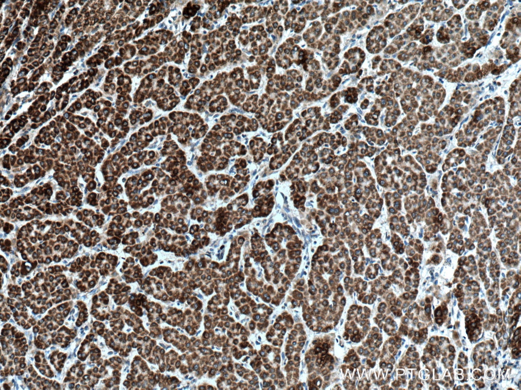 Immunohistochemistry (IHC) staining of human liver cancer tissue using BDH1 Polyclonal antibody (15417-1-AP)