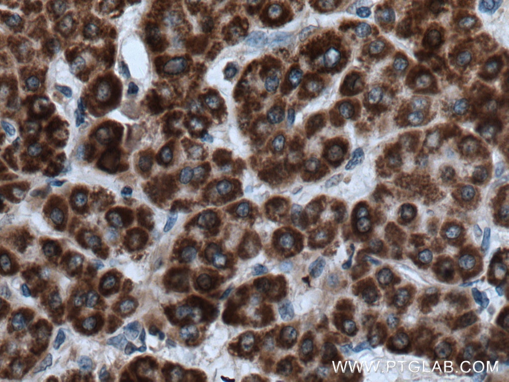 Immunohistochemistry (IHC) staining of human liver cancer tissue using BDH1 Polyclonal antibody (15417-1-AP)