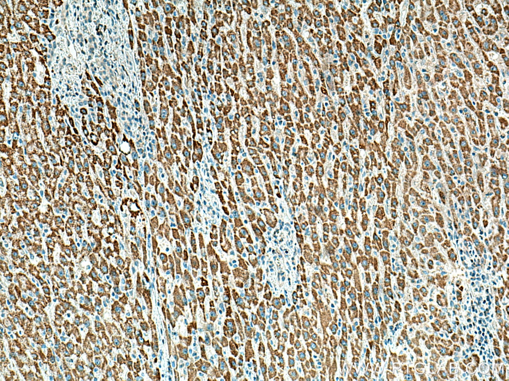 Immunohistochemistry (IHC) staining of human liver cancer tissue using BDH1 Monoclonal antibody (67448-1-Ig)