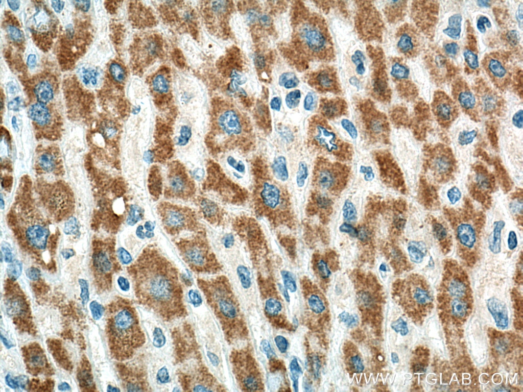 Immunohistochemistry (IHC) staining of human liver cancer tissue using BDH1 Monoclonal antibody (67448-1-Ig)