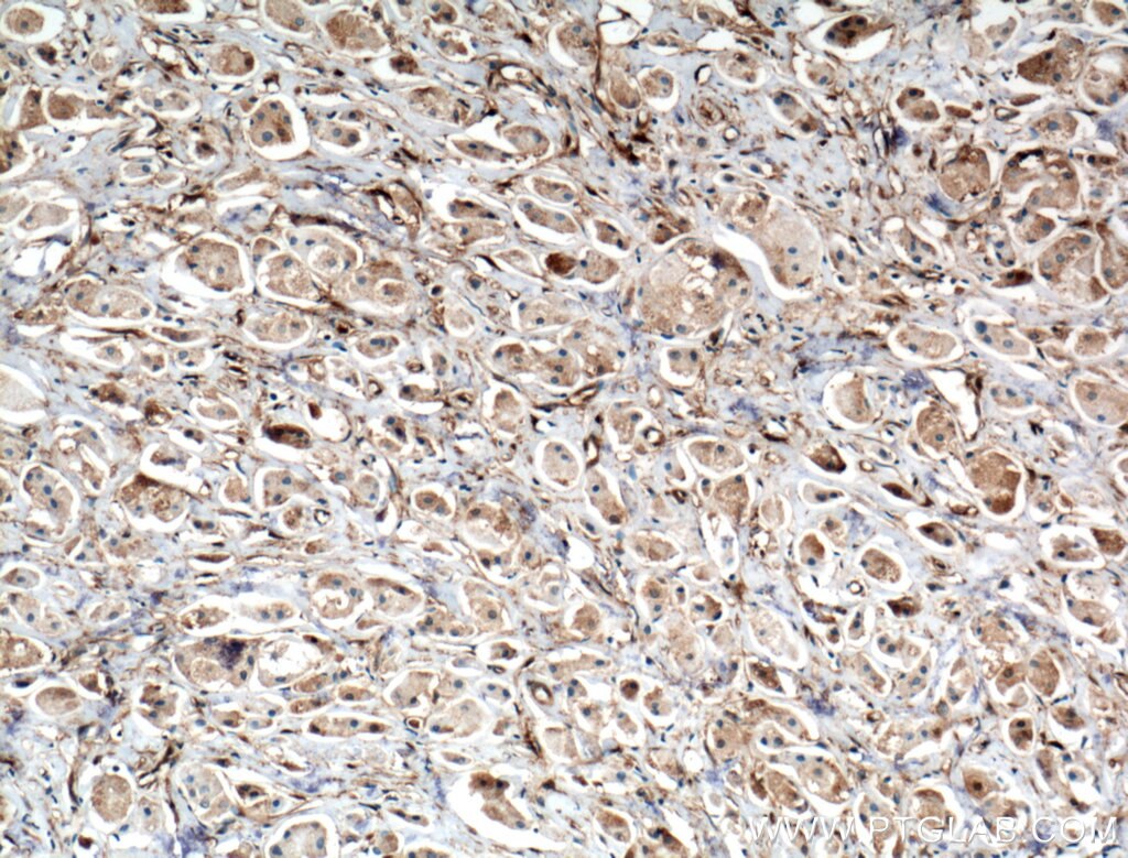 Immunohistochemistry (IHC) staining of human breast cancer tissue using BDH2 Polyclonal antibody (27207-1-AP)