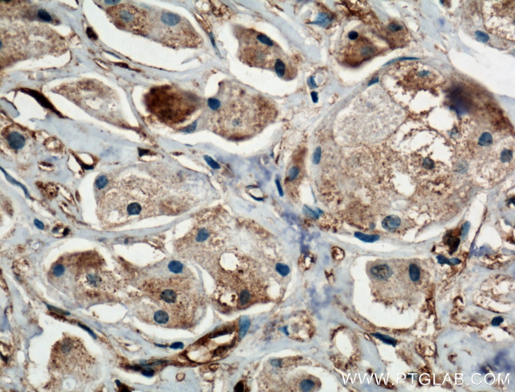 Immunohistochemistry (IHC) staining of human breast cancer tissue using BDH2 Polyclonal antibody (27207-1-AP)