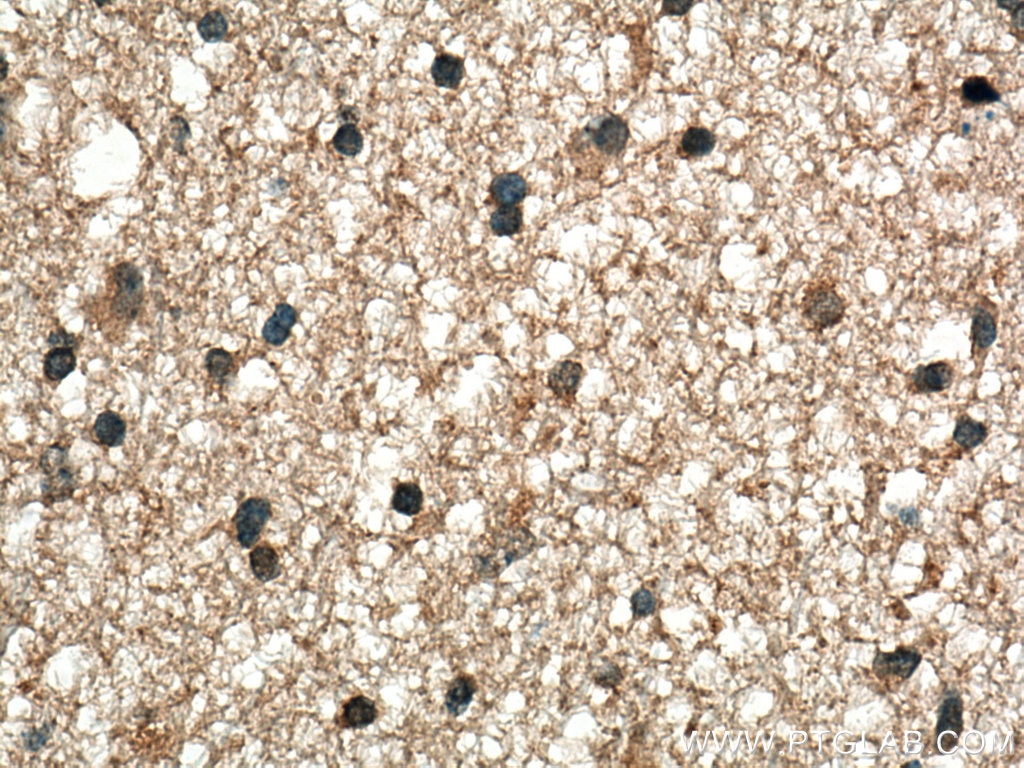 IHC staining of human gliomas using 28205-1-AP