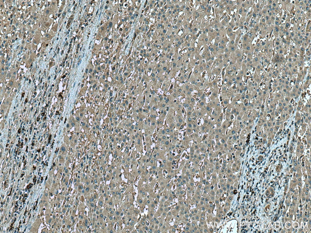 Immunohistochemistry (IHC) staining of human liver cancer tissue using Beclin 1 Polyclonal antibody (11306-1-AP)