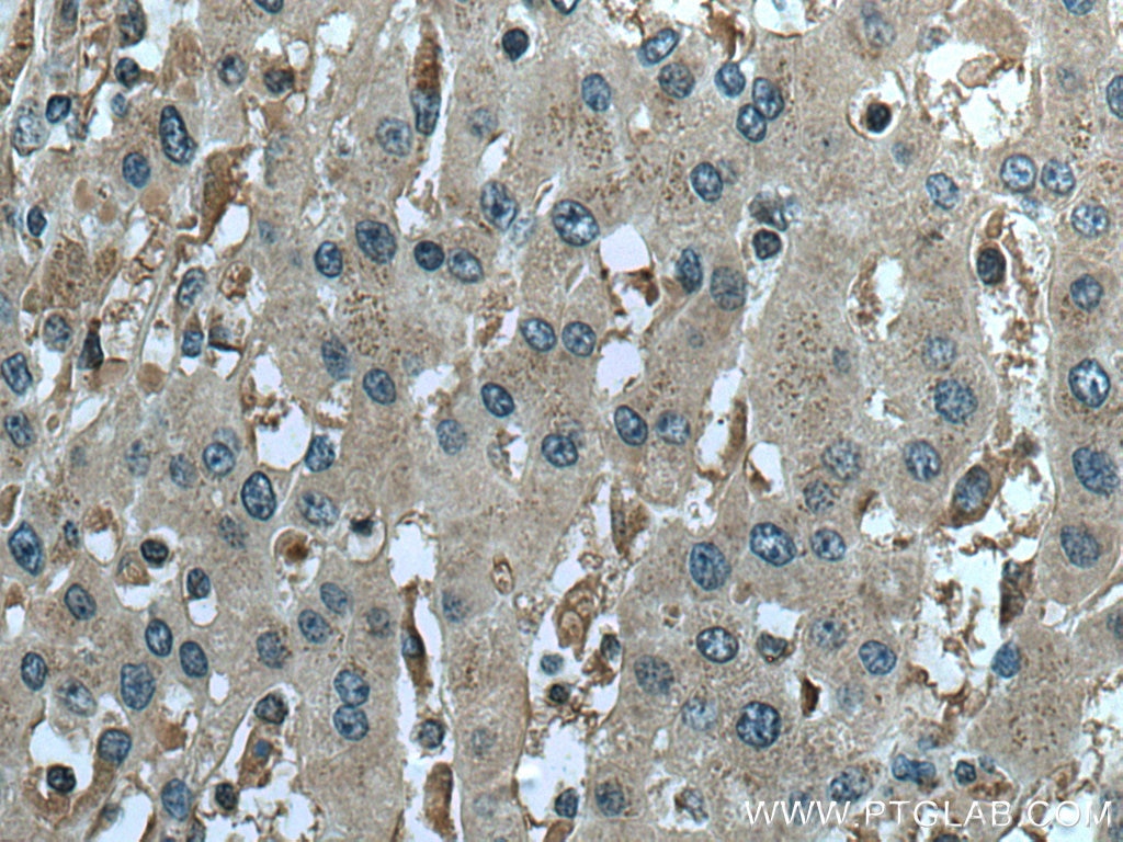 Immunohistochemistry (IHC) staining of human liver cancer tissue using Beclin 1 Polyclonal antibody (11306-1-AP)