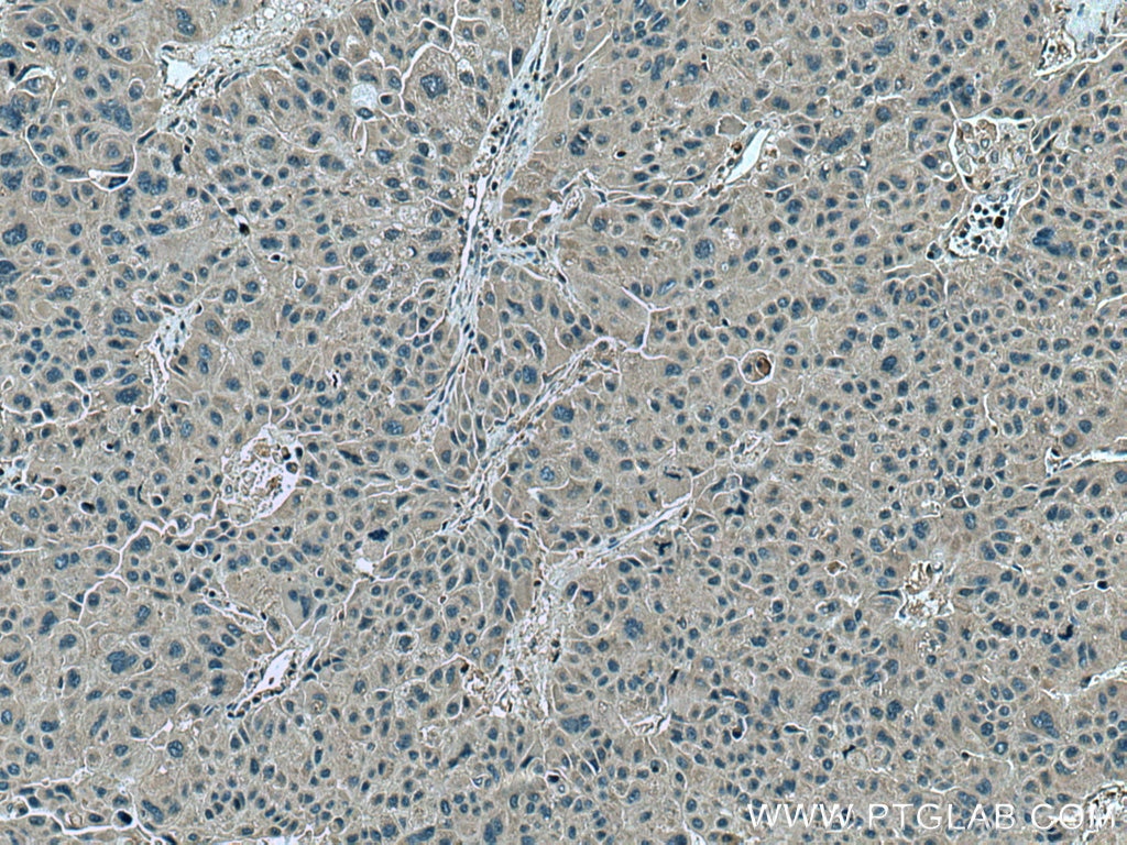 Immunohistochemistry (IHC) staining of human liver cancer tissue using Beclin 1 Polyclonal antibody (11306-1-AP)