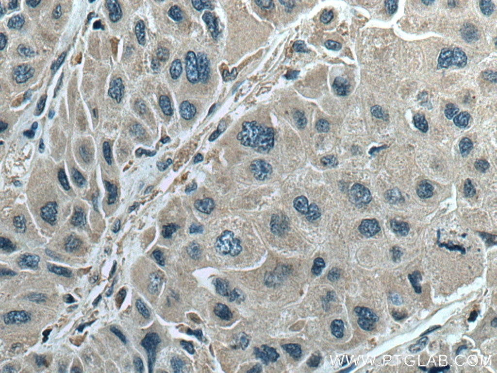 Immunohistochemistry (IHC) staining of human liver cancer tissue using Beclin 1 Polyclonal antibody (11306-1-AP)