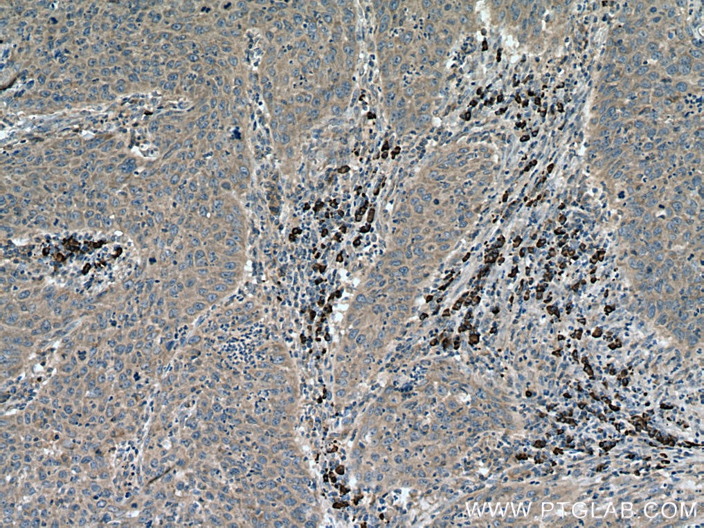 Immunohistochemistry (IHC) staining of human cervical cancer tissue using Beclin 1 Polyclonal antibody (11306-1-AP)