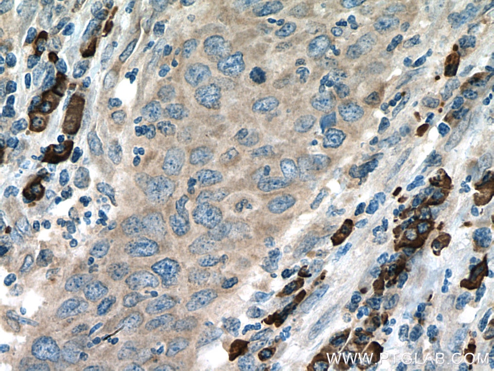 Immunohistochemistry (IHC) staining of human cervical cancer tissue using Beclin 1 Polyclonal antibody (11306-1-AP)