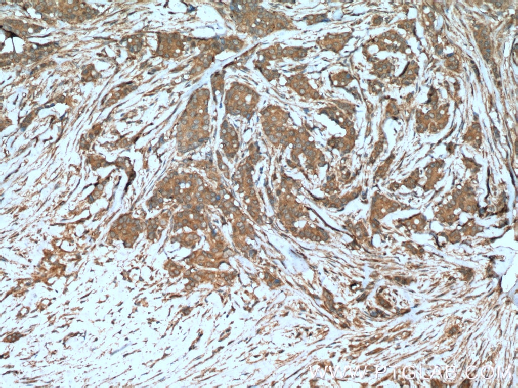 Immunohistochemistry (IHC) staining of human breast cancer tissue using Beclin 1 Polyclonal antibody (11306-1-AP)