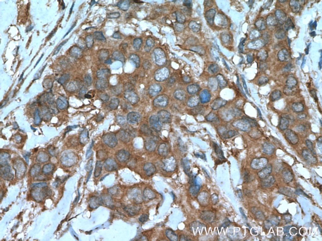 Immunohistochemistry (IHC) staining of human breast cancer tissue using Beclin 1 Polyclonal antibody (11306-1-AP)