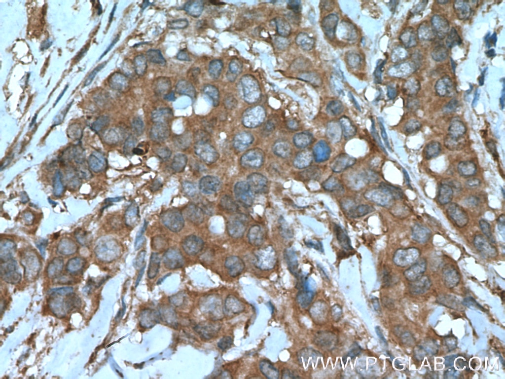 IHC staining of human breast cancer using 11306-1-AP