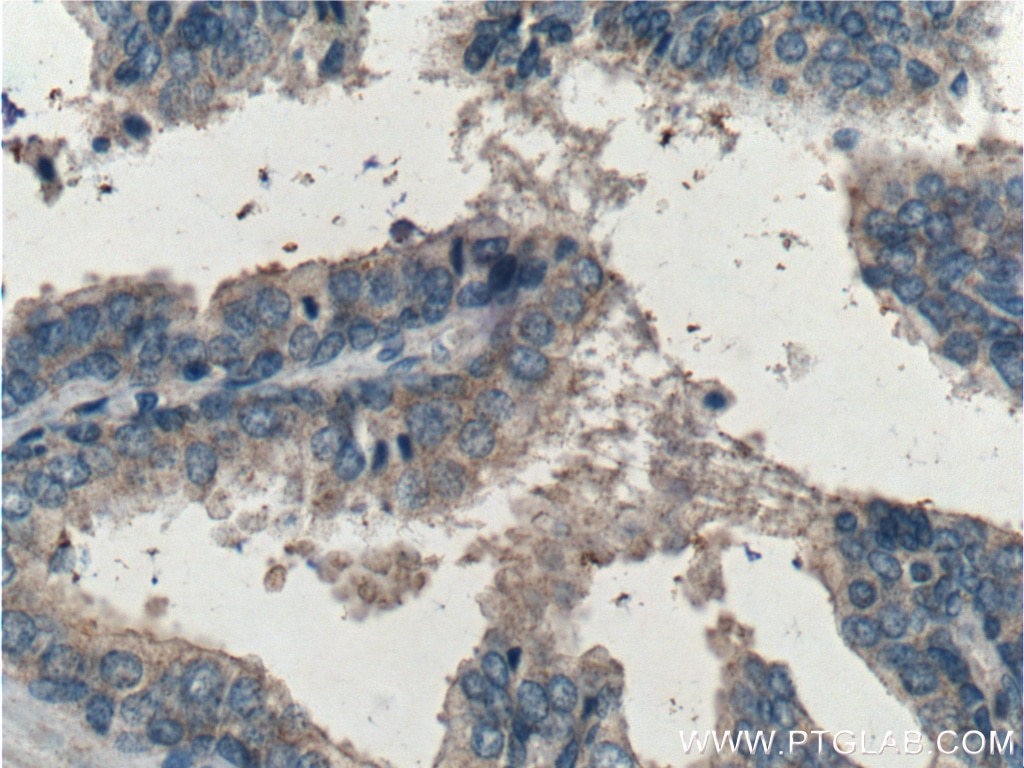 Immunohistochemistry (IHC) staining of human prostate hyperplasia tissue using Beclin 1 Polyclonal antibody (11306-1-AP)