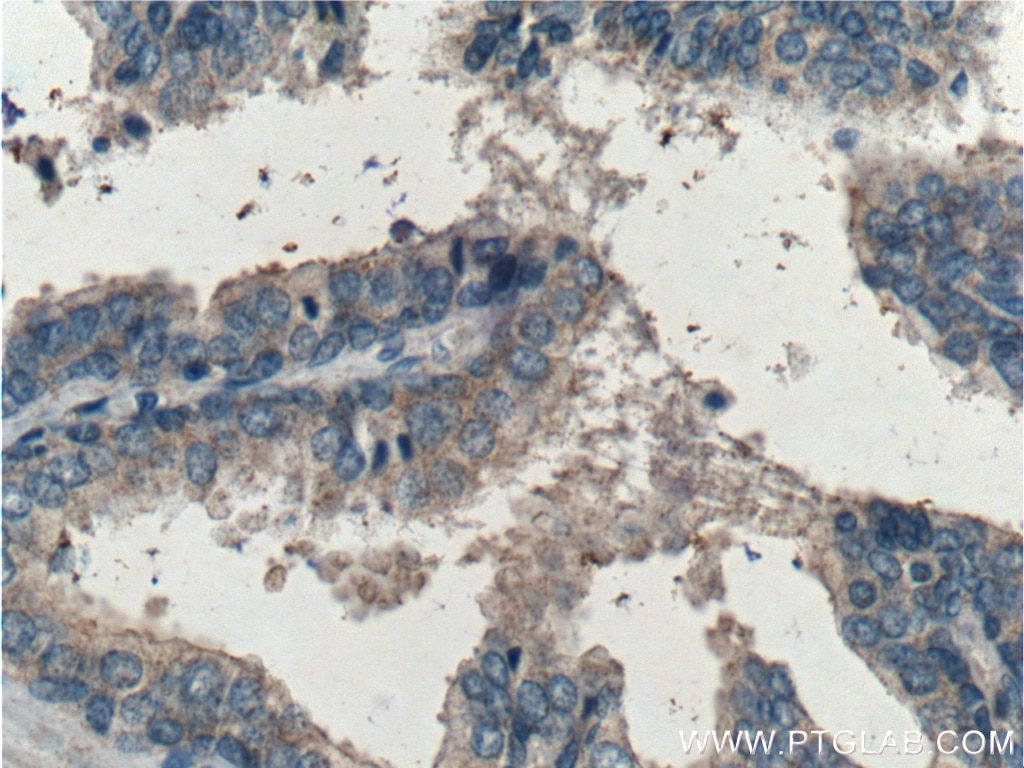 IHC staining of human prostate hyperplasia using 11306-1-AP