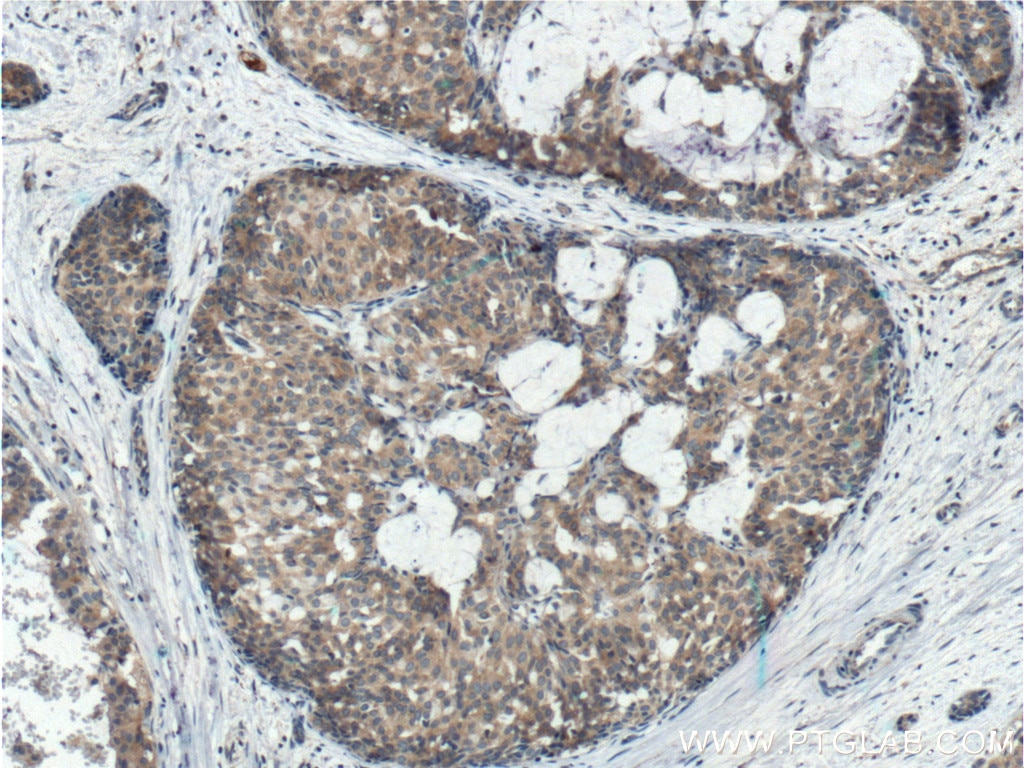 Immunohistochemistry (IHC) staining of human breast hyperplasia tissue using Beclin 1 Polyclonal antibody (11306-1-AP)