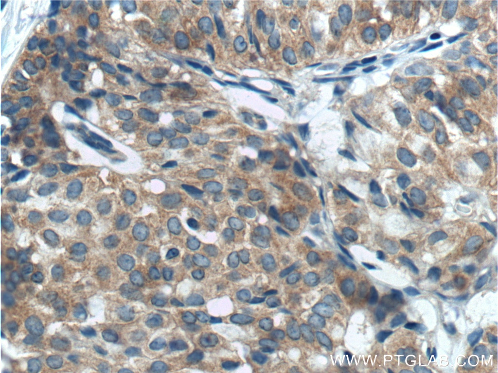 Immunohistochemistry (IHC) staining of human breast hyperplasia tissue using Beclin 1 Polyclonal antibody (11306-1-AP)