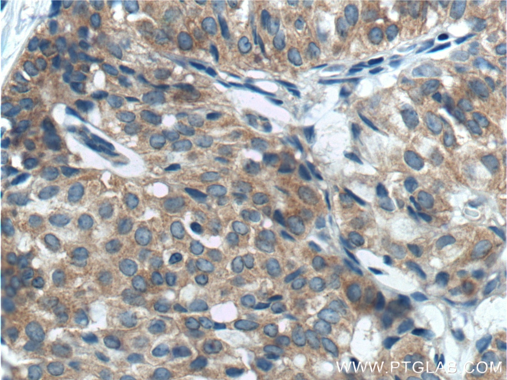 IHC staining of human breast hyperplasia using 11306-1-AP