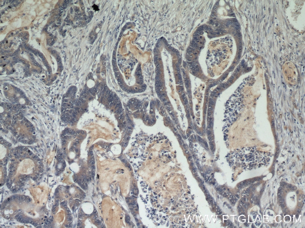 Immunohistochemistry (IHC) staining of human colon cancer tissue using Beclin 1 Polyclonal antibody (11306-1-AP)