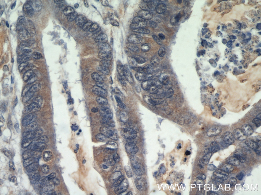 Immunohistochemistry (IHC) staining of human colon cancer tissue using Beclin 1 Polyclonal antibody (11306-1-AP)