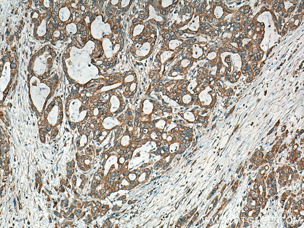 Immunohistochemistry (IHC) staining of human pancreas cancer tissue using BEGAIN Polyclonal antibody (14956-1-AP)