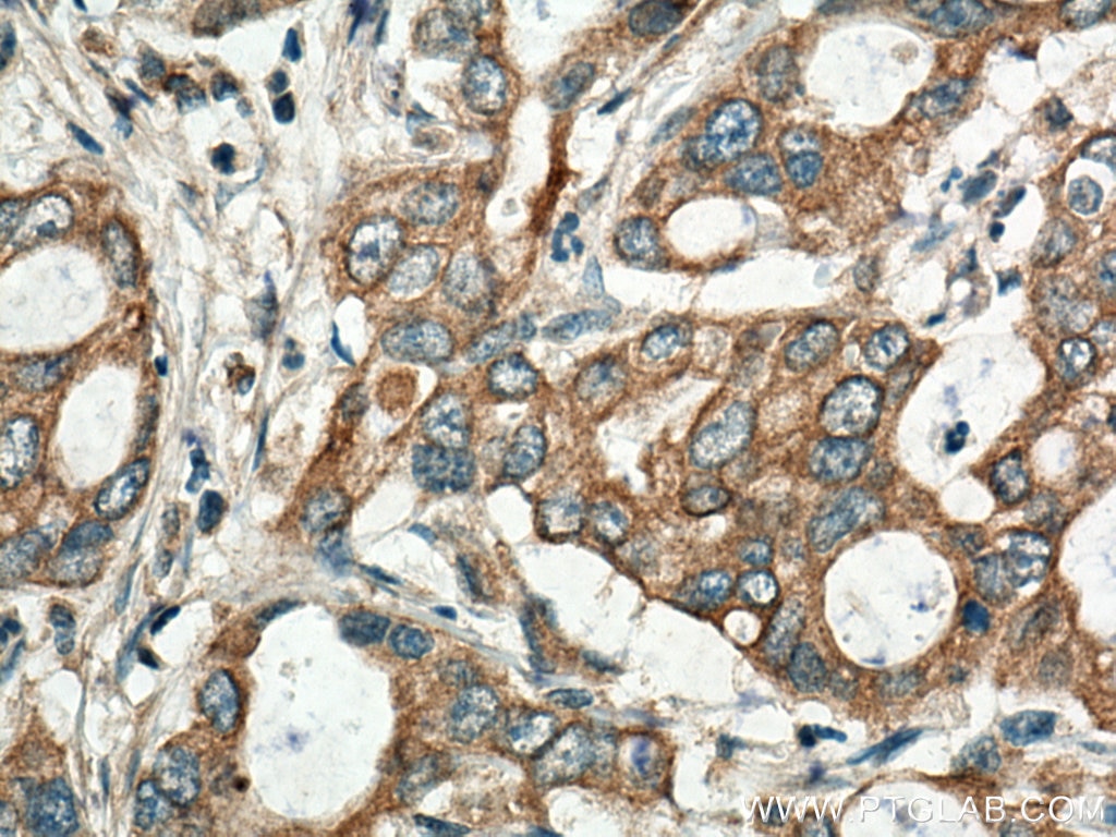 Immunohistochemistry (IHC) staining of human pancreas cancer tissue using BEGAIN Polyclonal antibody (14956-1-AP)