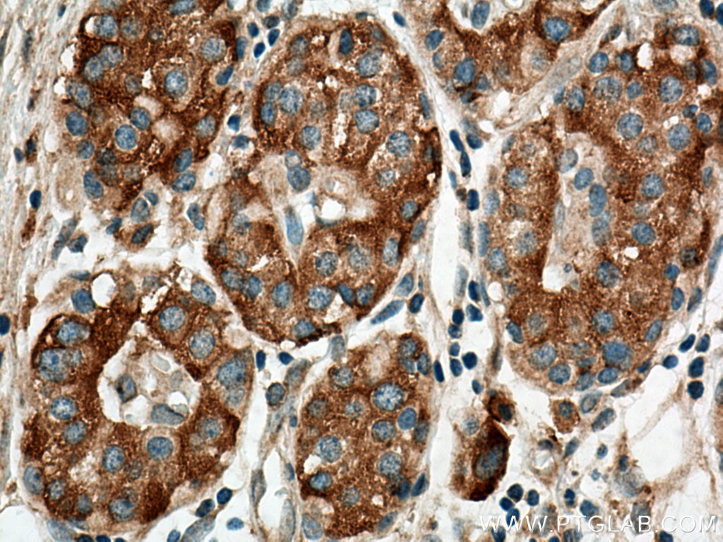 Immunohistochemistry (IHC) staining of human pancreas cancer tissue using BEGAIN Polyclonal antibody (14956-1-AP)