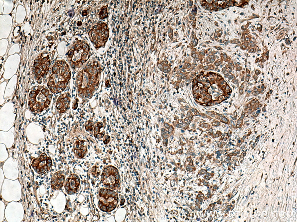 IHC staining of human pancreas cancer using 14956-1-AP