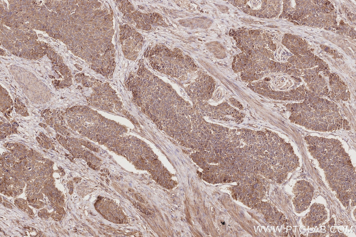 Immunohistochemistry (IHC) staining of human stomach cancer tissue using BEGAIN Polyclonal antibody (14956-1-AP)
