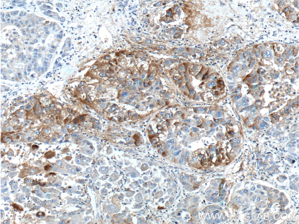 Immunohistochemistry (IHC) staining of human liver cancer tissue using BEND3 Polyclonal antibody (23101-1-AP)