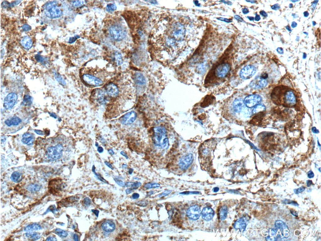 Immunohistochemistry (IHC) staining of human liver cancer tissue using BEND3 Polyclonal antibody (23101-1-AP)